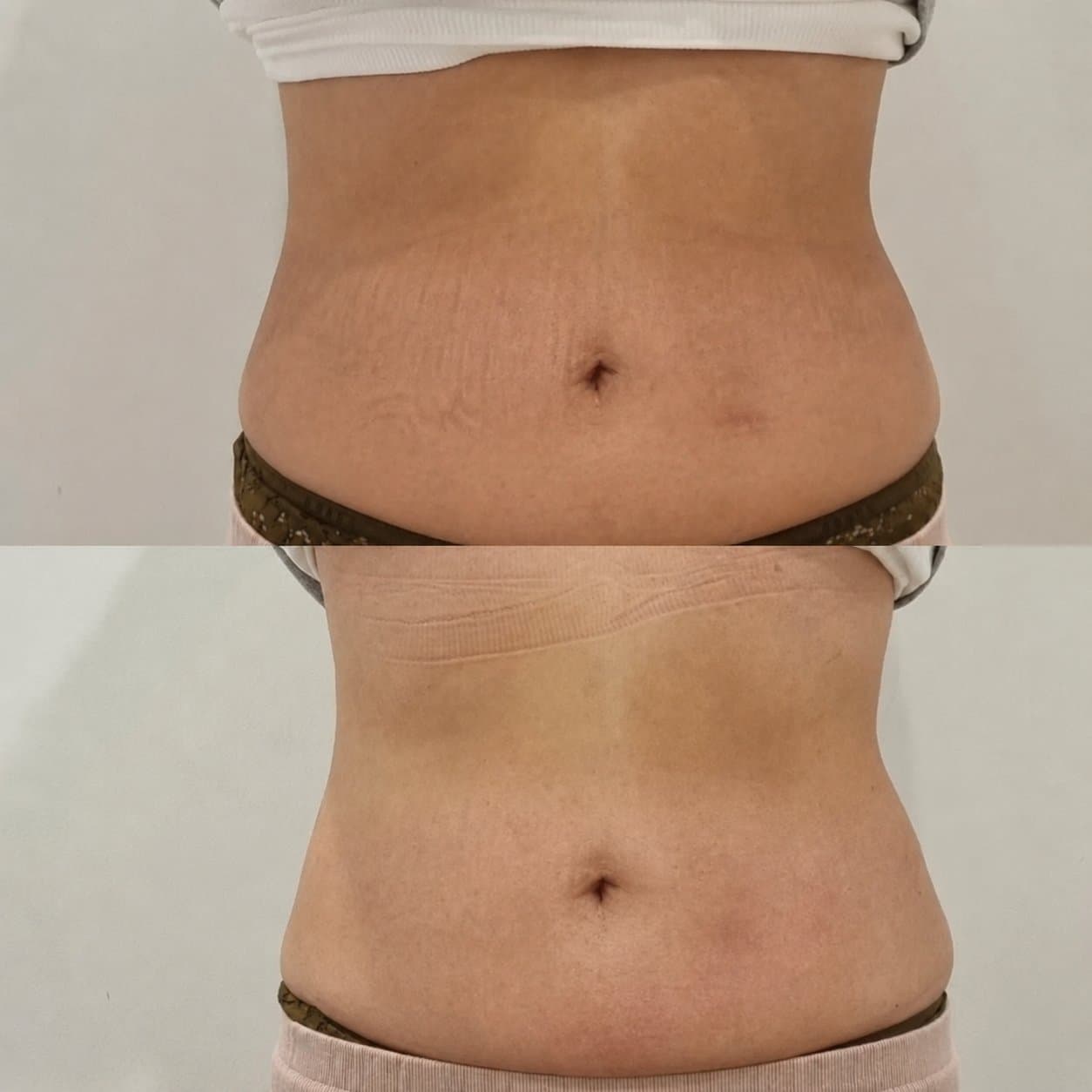 Before and after of an ULFIT body treatment showing a firmer, more toned tummy